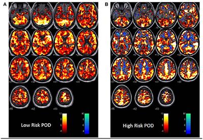 A Novel Stress-Diathesis Model to Predict Risk of Post-operative Delirium: Implications for Intra-operative Management